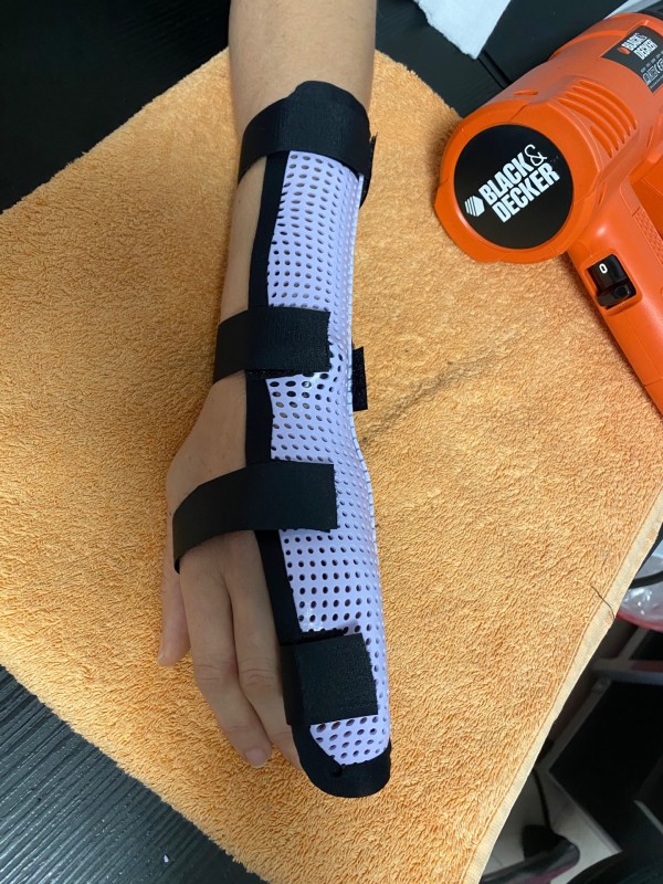 Orthèse thermoformée sur mesure pour arthrose du pouce à Cuers proche de Toulon dans le Var