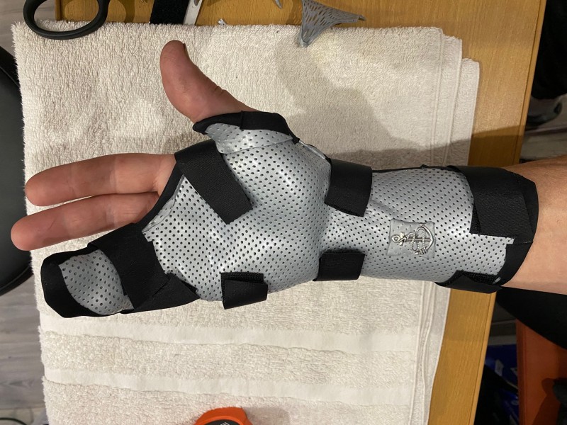 Orthese de main sur mesure pour fracture du 5ème métacarpien à Carnoules proche de Brignoles
