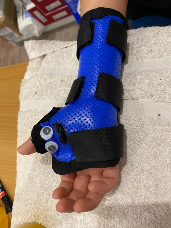 Orthèse sur mesure pour enfant suite fracture à Cuers dans le Var