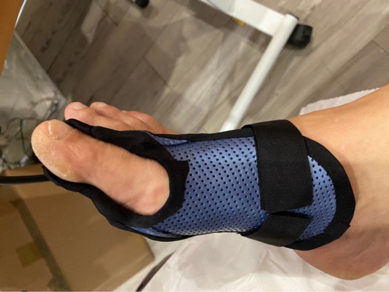 orthese hallux valgus corrective pour la nuit sur mesure a sollies
