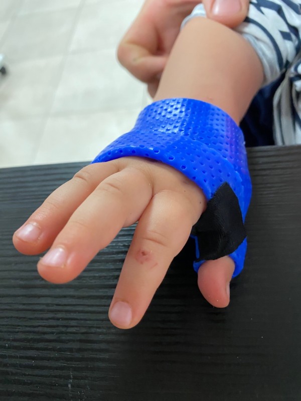 Orthèse sur mesure pour enfant suite fracture à Toulon dans le Var