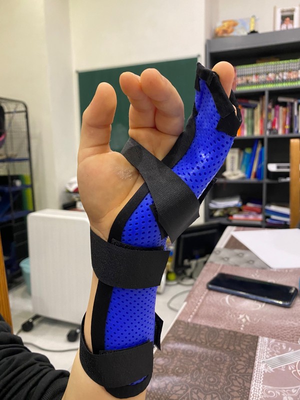Orthèse thermoformée sur mesure pour arthrose du pouce à Carnoules proche de Toulon dans le Var