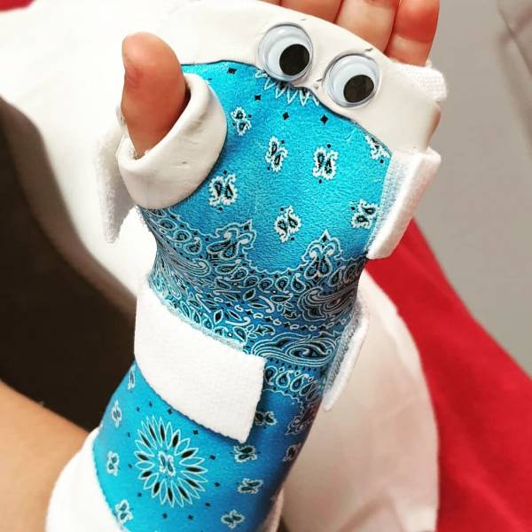 orthèse poignet main pour enfant sur mesure pour fracture en motte de beurre sollies pont