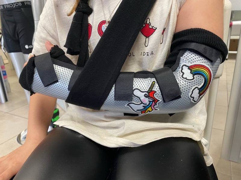 Orthèse en remplacement du plâtre pour immobilisation stricte de coude et du poignet avec blocage de la prono-supination post traumatique sur Solliès-Pont, Carnoules et Toulon dans le 83