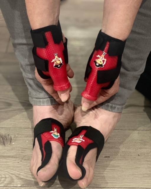 orthèse thermoformable fixée par des scratchs