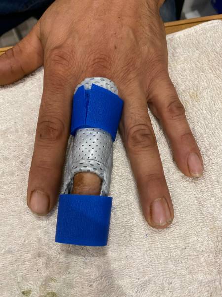 orthèse pour arthrose sur Carnoules dans le Var