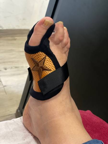 attelle de nuit sur mesure pour hallux valgus sur Toulon près de la clinique de la main