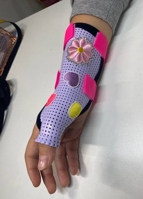 ORTHESE SUR MESURE POUR DOULEUR CANAL CARPIEN POUR IDEL EN URGENCE