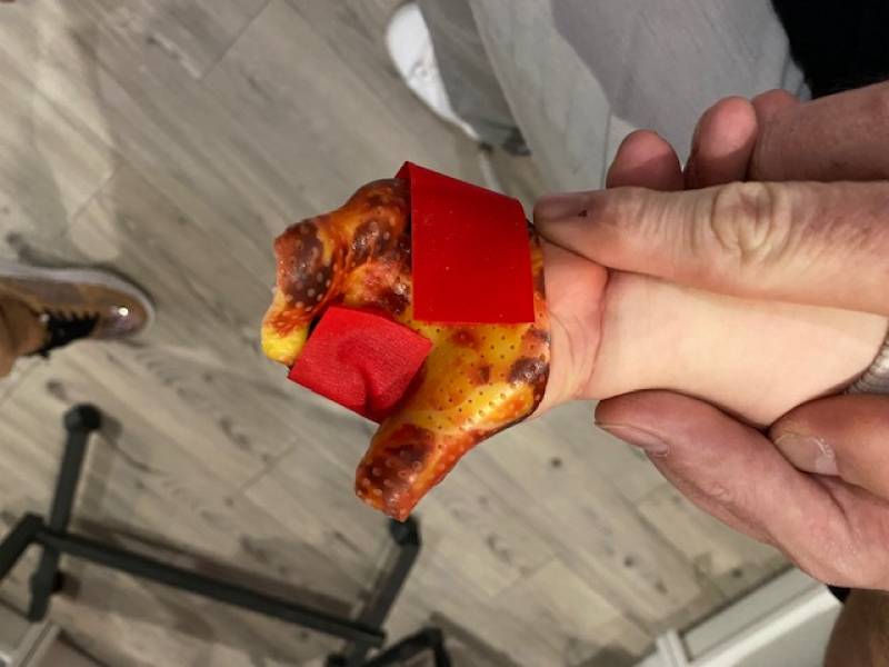 attelle sur mesure pour nourrisson à Toulon, Solliès-pont et Carnoules dans le Var