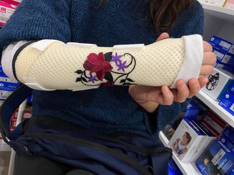 attelle sur mesure pour fracture du radius dans le 83