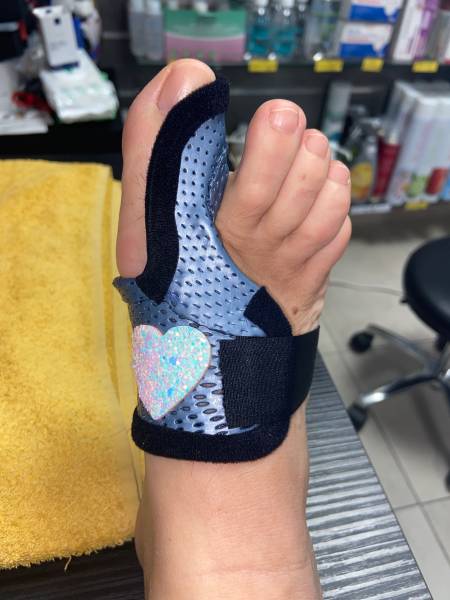 orthese thermomoulée pour hallux valgus sur toulon près de la clinique de la main