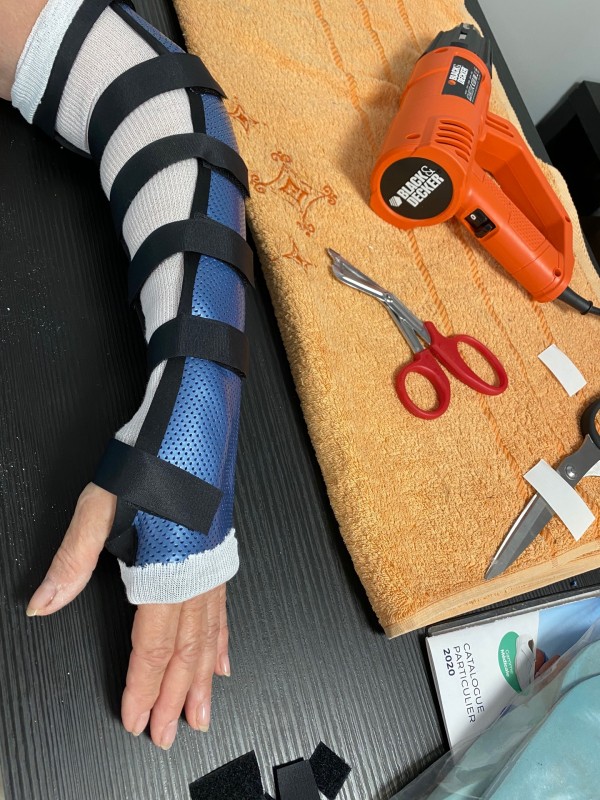 Orthèse sur mesure pour enfant suite fracture à Carnoules dans le Var