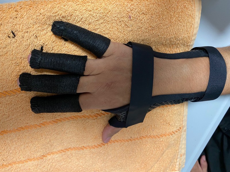 orthèse sur mesure et personnalisée dans le Var