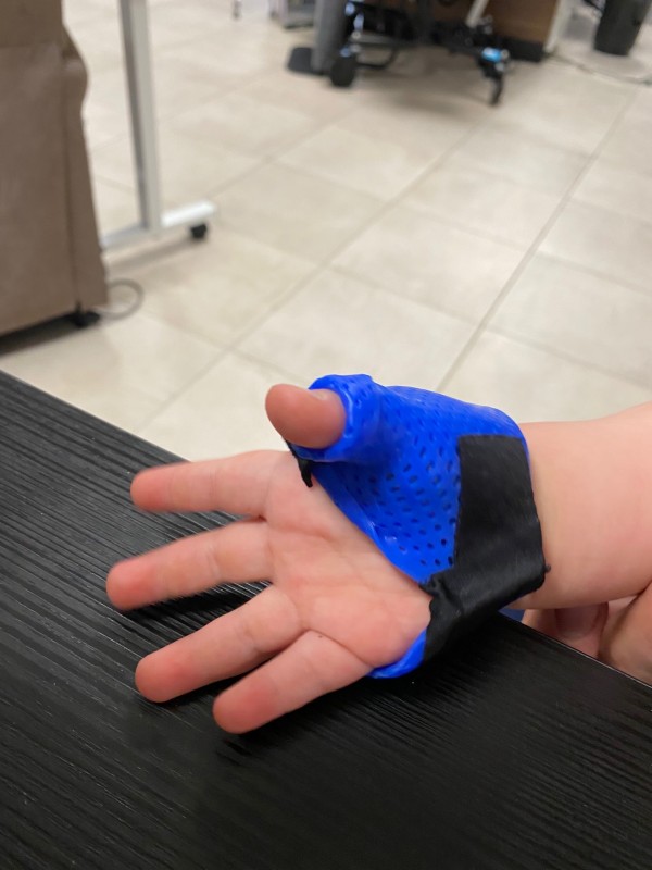 Orthèse sur mesure pour enfant suite fracture à La-valette-du-var dans le Var