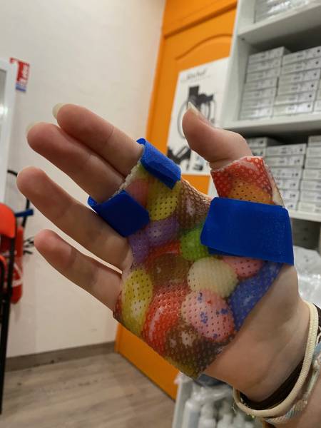 attelle personnalisée et sur mesure pour enfant dans le Var