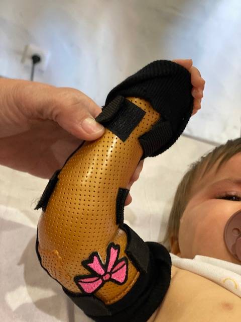 orthèse sur mesure pour fracture radius sur bébé à Toulon près de la clinique de la main