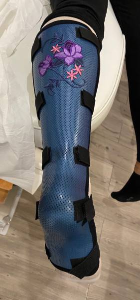 Attelle thermoformable sur mesure pour adultes et enfants sur Solliès-Pont et Toulon dans le Var près de la clinique de la main