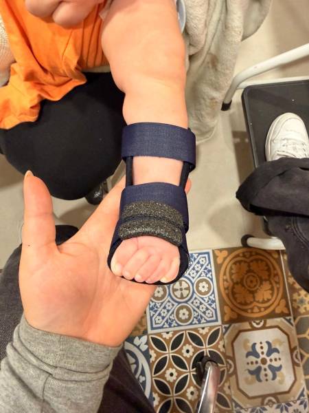 Centre d’orthopédie pédiatrique à Toulon, nous concevons des dispositifs sur mesure pour le métatarsus varus.