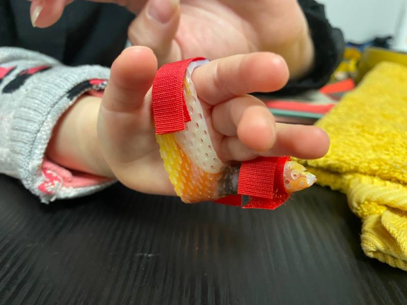 Orthèse thermomoulée sur mesure proche de Cuers à domicile dans le Var