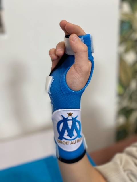 Orthese thermoformée pour un fan de l'olympique de Marseille