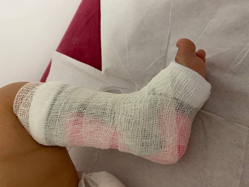 orthese pour pied enfant suite fracture