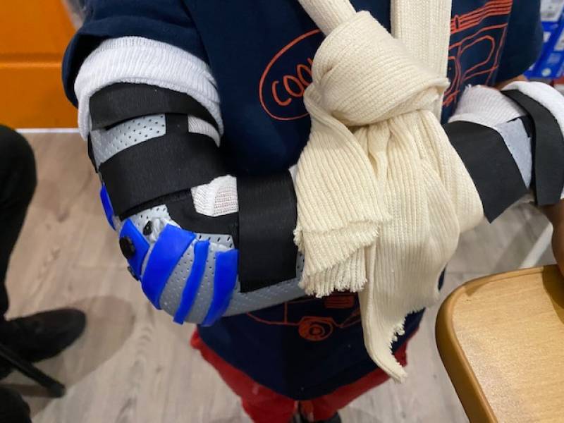 immobiliser une articulation avec une attelle sur mesure dans le Var