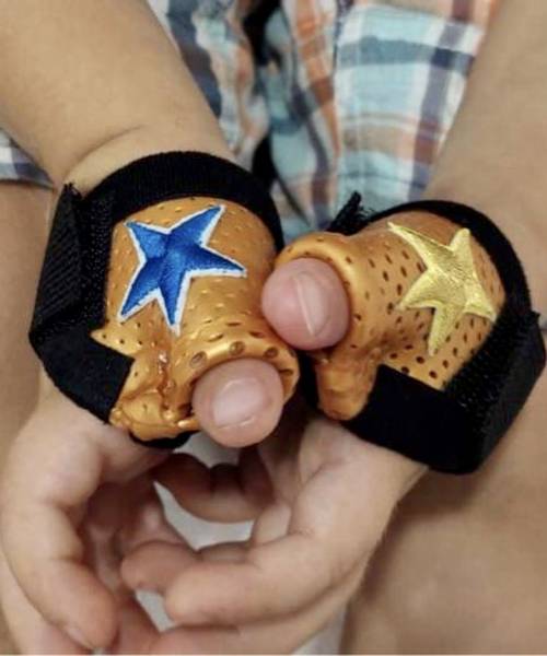 orthese de pouce sur mesure sur un nourrisson à Carnoules près de Cuers