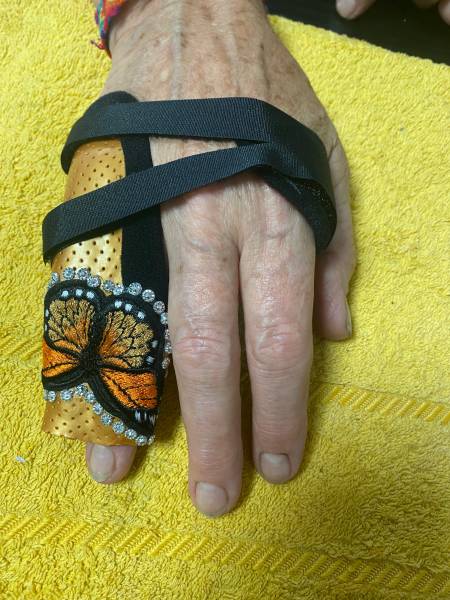 syndactilie prohese de doigt en plastique sur mesure à ollioules proche de la seyne sur mer