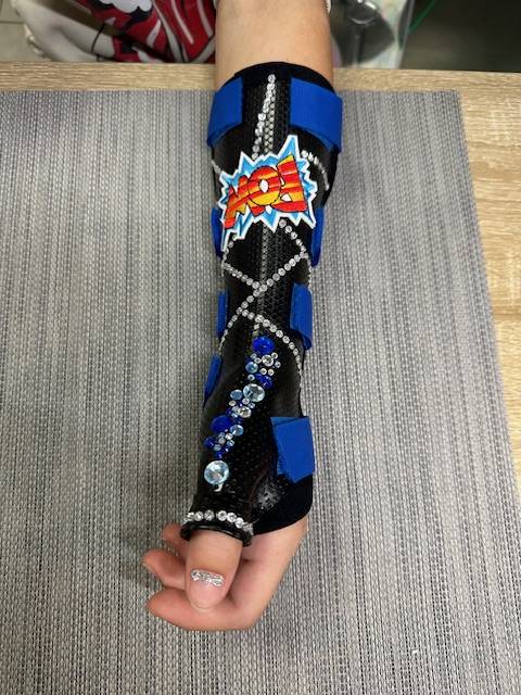 Orthèses sur mesure moulées sur le patient pour une meilleur immobilisation