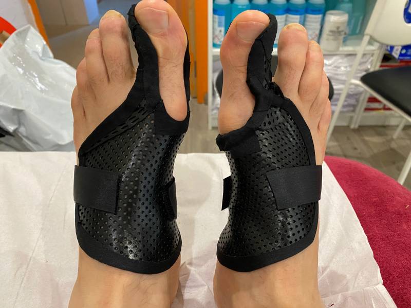 orthèse orteil hallux valgus sur mesure dans le var sur Solliès-Pont près et Carnoules près de Signes