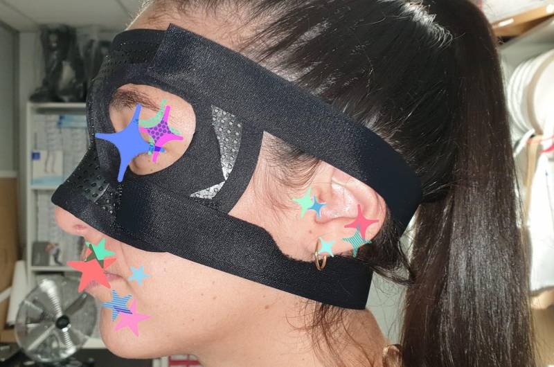 Orthèse thermomoulée sur mesure pour nez cassé sur Carnoules près de Pierrefeu du Var