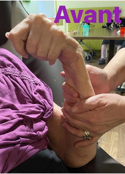 Orthèse thermoformée sur mesure pour fracture adulte et enfant à Carnoules proche de la Londe