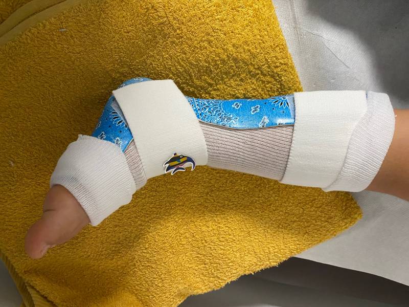 attelle de pied sur mesure 