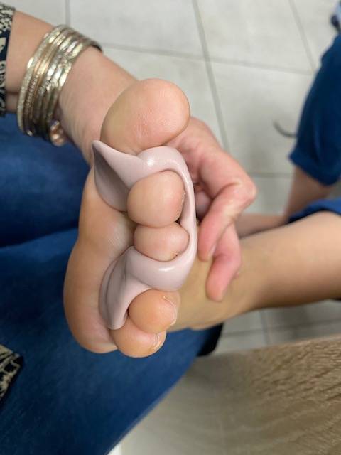 Orthoplastie de protection en silicone pour orteils réalisée par moulage sur Toulon, Carnoules et Solliès près de La Garde