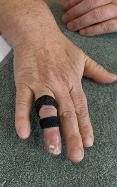 Orthèse dynamique main avec prescription médicale à Toulon