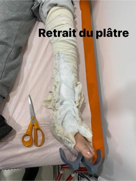 retrait de plâtre pour mettre en place une attelle thermoformée plus légère sur toulon
